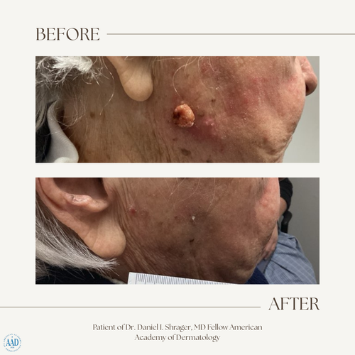 Before and after electronic brachytherapy for skin cancer, Alpha Dermatology case 22