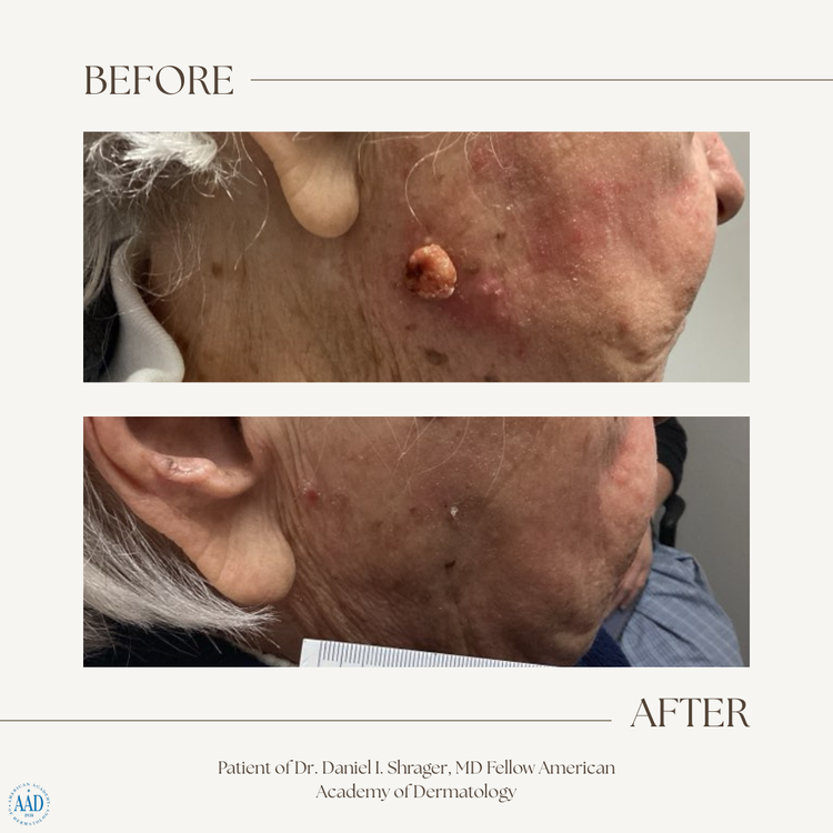 Cheek skin cancer before and after electronic brachytherapy