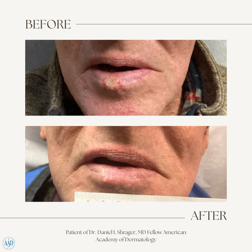 Before and after electronic brachytherapy for skin cancer, Alpha Dermatology case 17