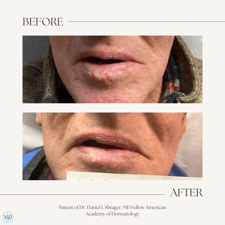 Upper lip skin cancer before and after electronic brachytherapy