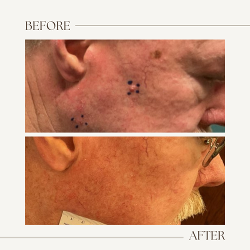 Before and after electronic brachytherapy for skin cancer, Alpha Dermatology case 23