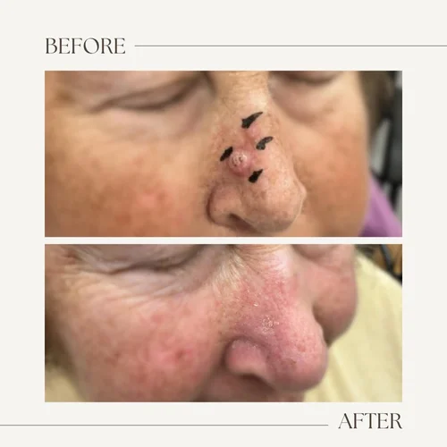 Before and after electronic brachytherapy for skin cancer, Alpha Dermatology case 32