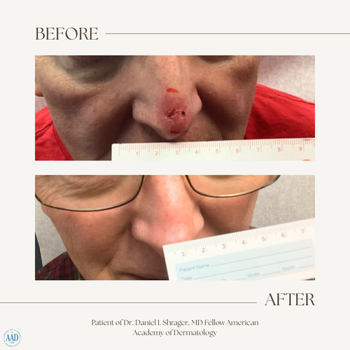 Before and after electronic brachytherapy for skin cancer, Alpha Dermatology case 20
