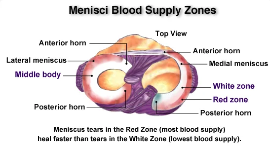 Do I Really Want My Meniscus Tear Repaired?