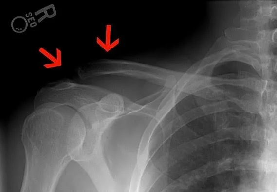 A Grade 2 AC Shoulder Separation