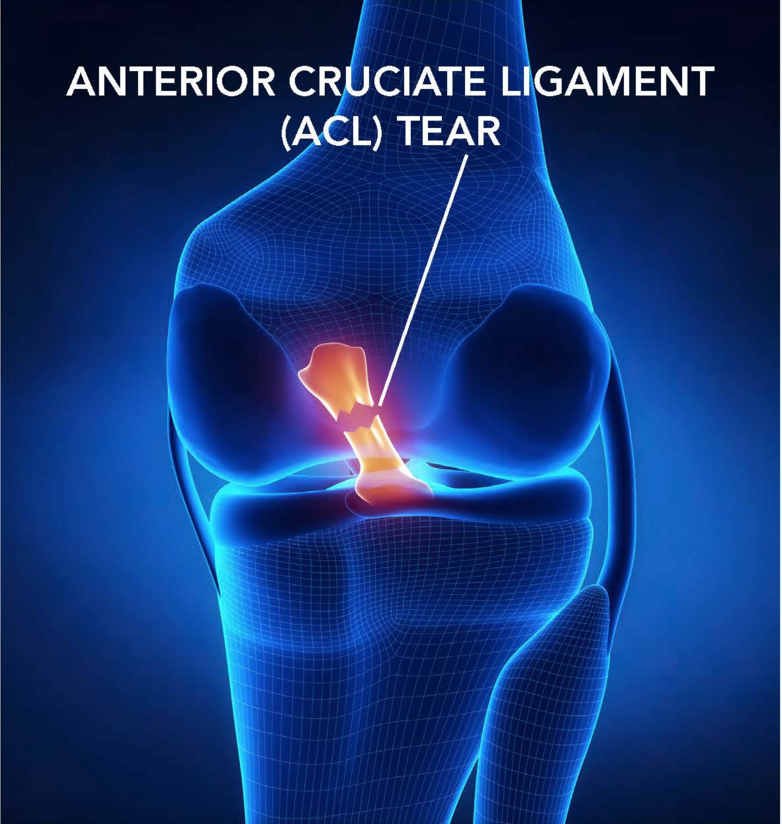 Here's an ACL tear. 
