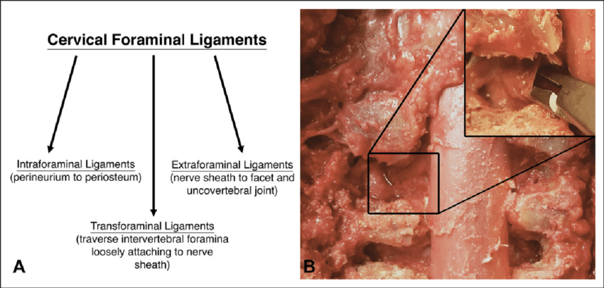 Panel-A-Classification-of-cervical-foraminal-ligaments-with-anatomical-location-Panel.png