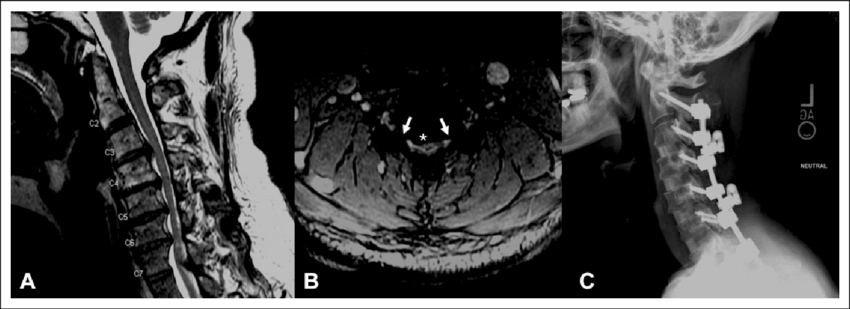 Panel-A-Sagittal-magnetic-resonance-imaging-MRI-of-a-clinical-case-of-C5-palsy-C5P.png