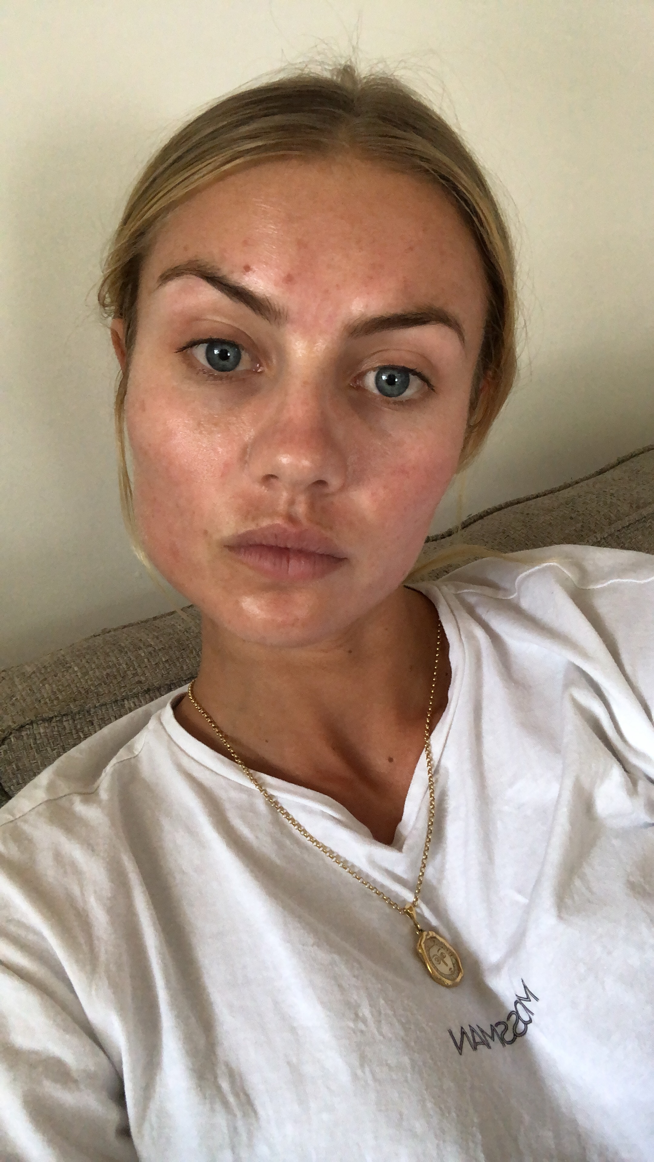 Elyse Knowles after the micro kneedling from Aesthetica 1.JPG