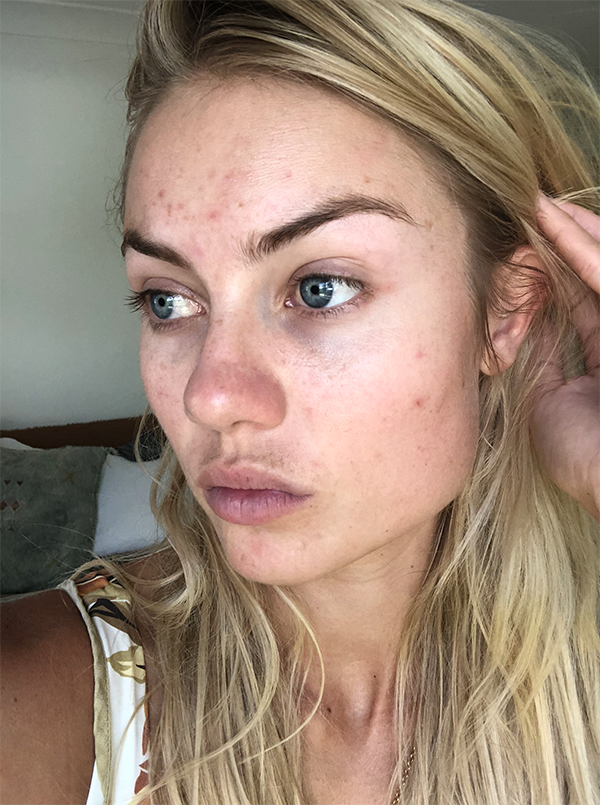 Elyse Knowles Skin Update May 2019 6.png