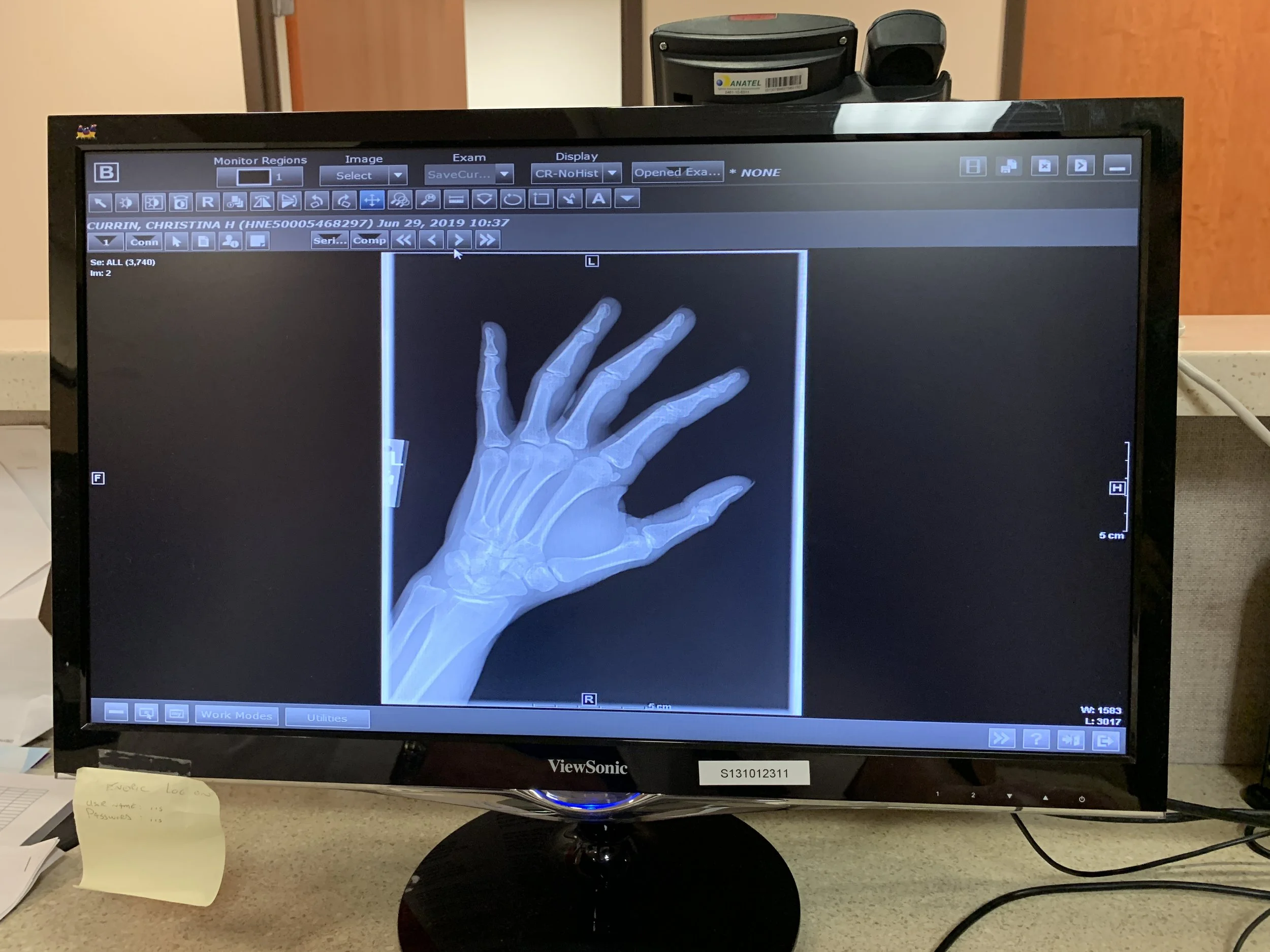 tina broken finger.JPG