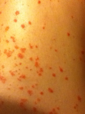 A small section of my thigh at the moment. Imagine this rash, all over. And this is at its best, after vigorous application of topical steroids. I feel like a mutant monster :S