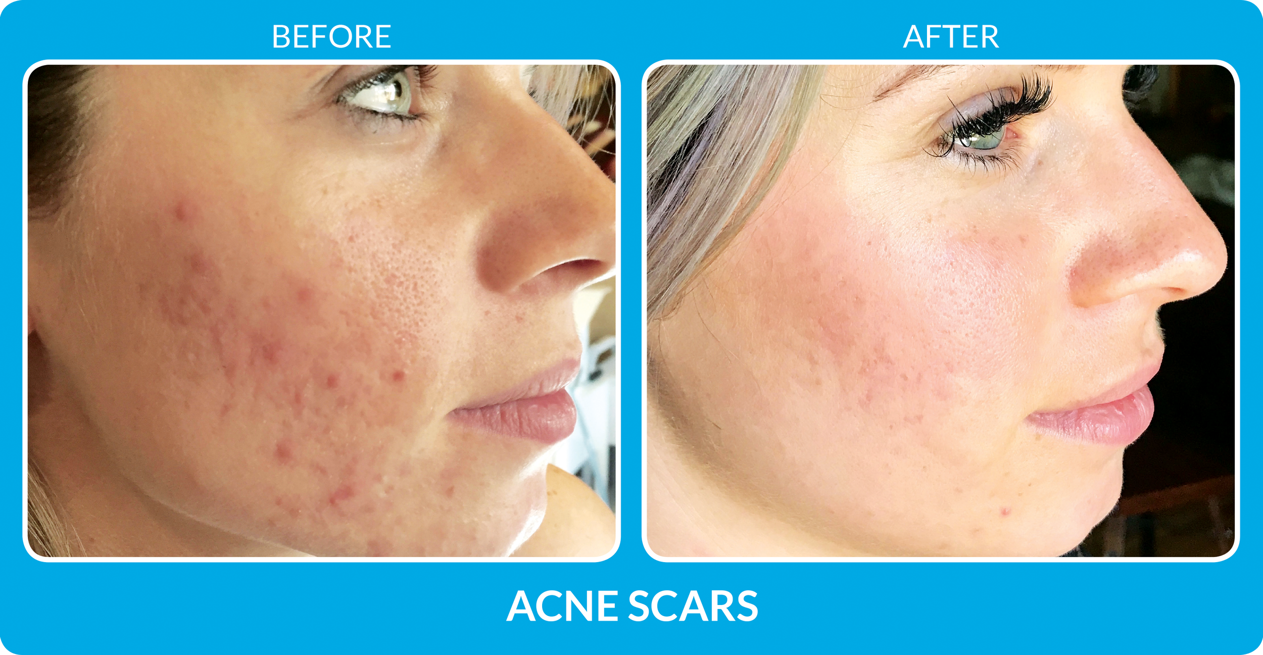 acne scars 2 procell.png