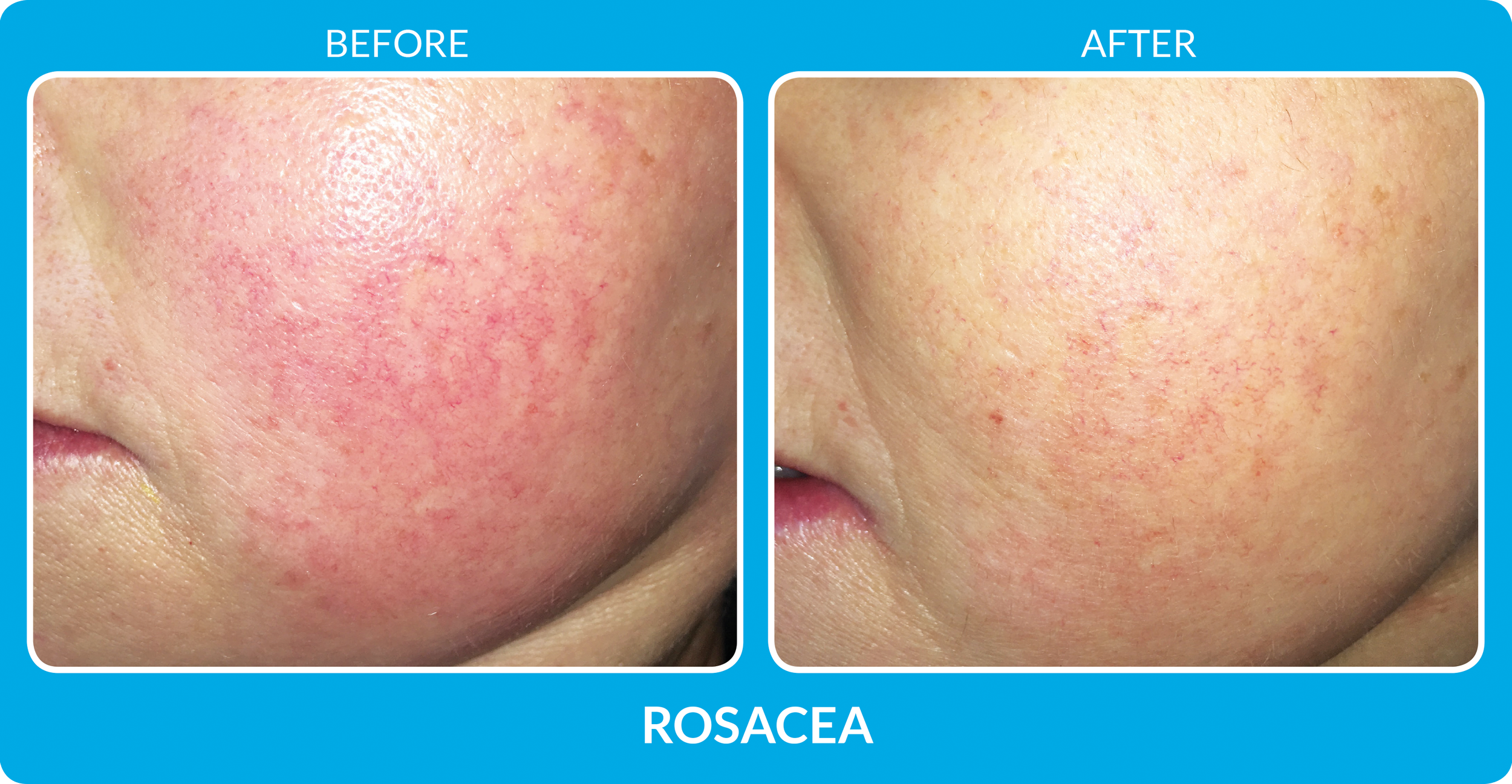 Rosacea_B&A_procell.png