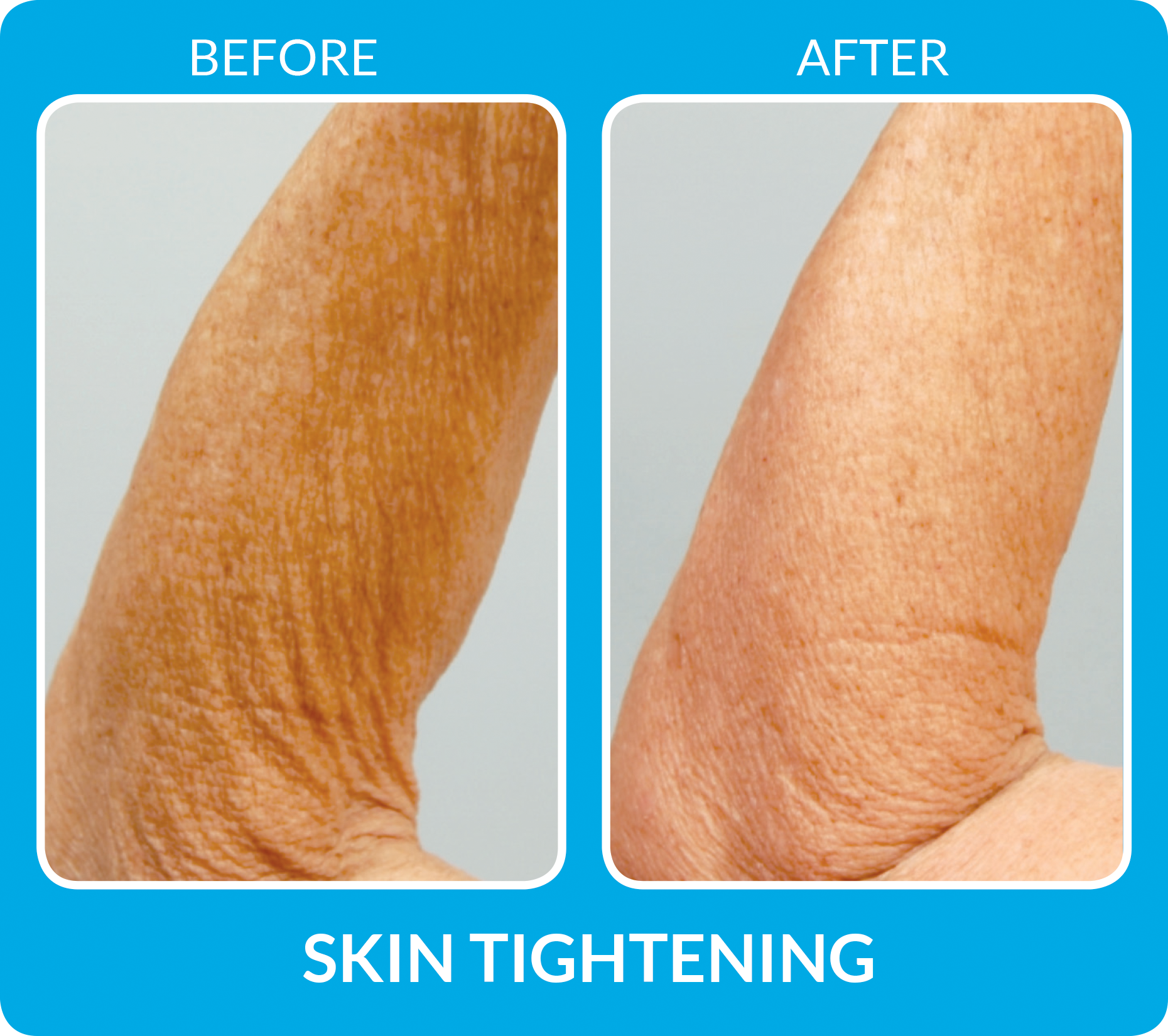 SkinTightening_B&A-procell.png