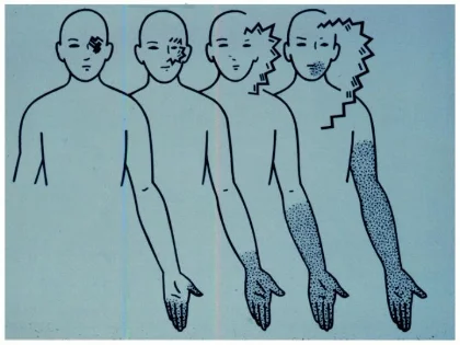 migraine_aura.jpg