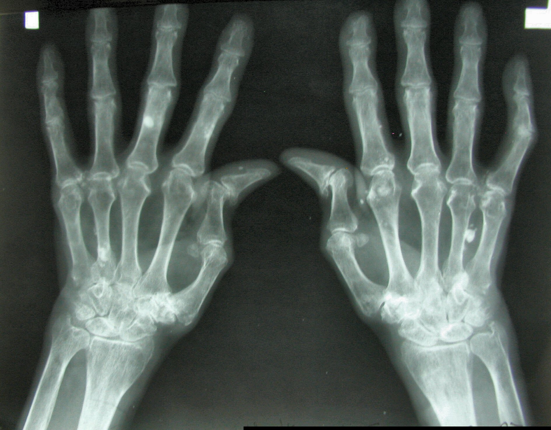 rheumatoid arthritis ahol kezelik flight club london