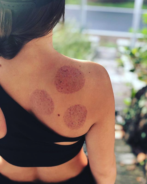 Here’s a picture of me right after I got my first cupping on my shoulder and my life was changed.