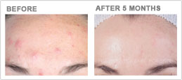 acne-sun-induced-hyperpigmentation-sm.jpg