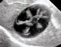Gall bladder with a mucocele -> risk of rupture and cholestasis (blockage of bile duct)