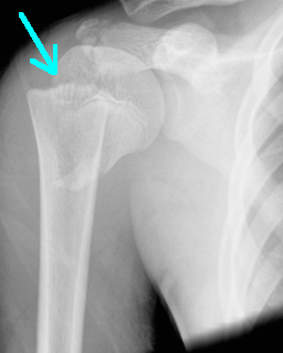 Displaced fracture of upper humerus through growth plate.