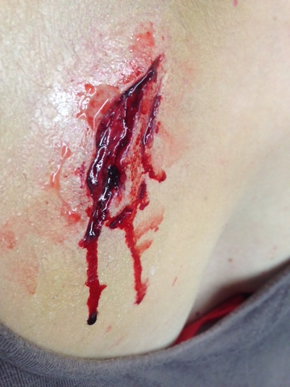 SILICONE WOUND APPLIANCE