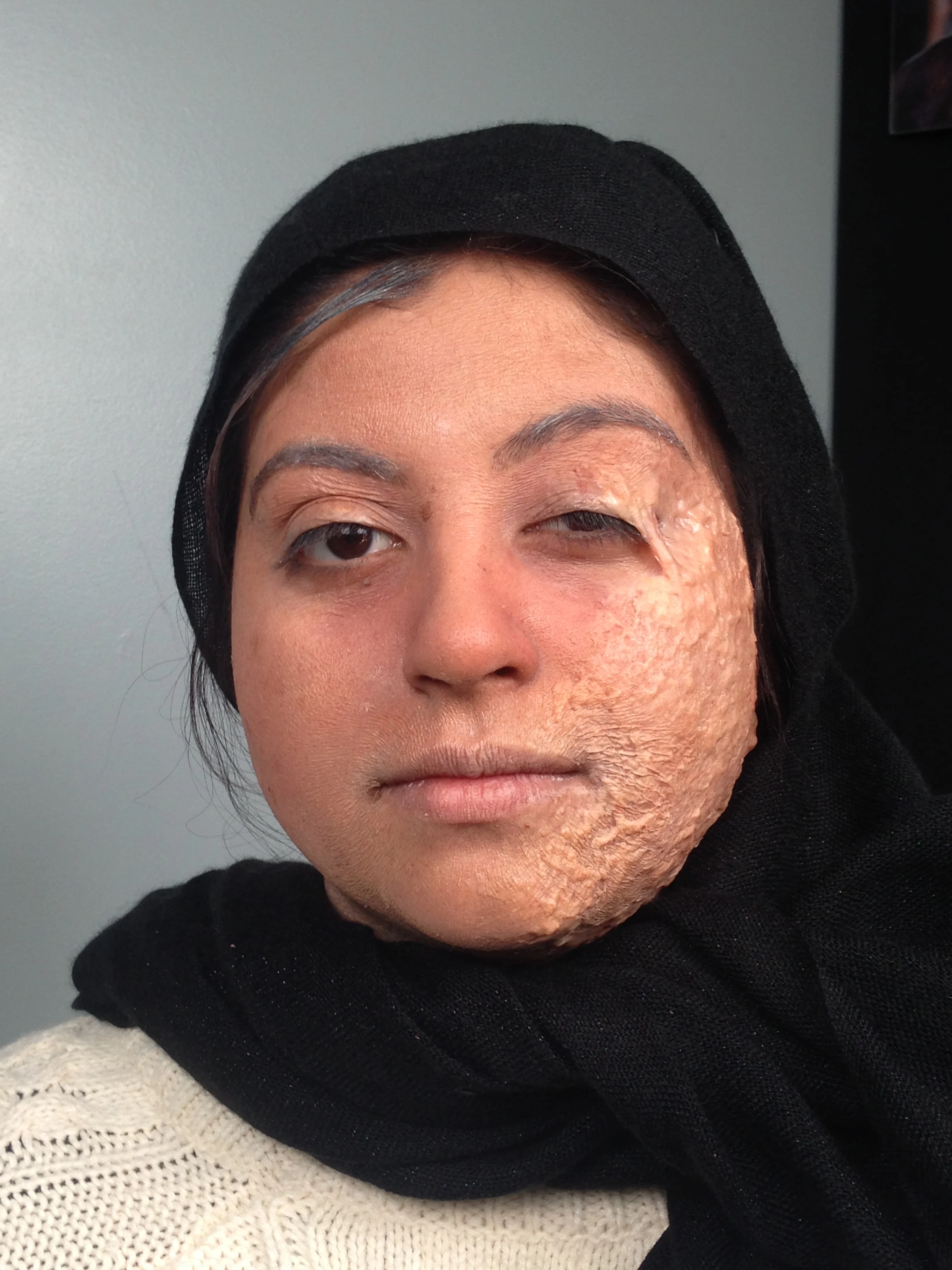 OLD BURNED VICTIM
