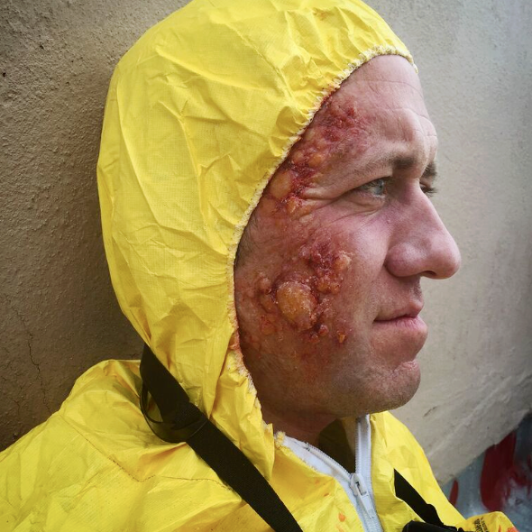  Face Prosthetics / Blisters created by Tinsley Transfers Applied by Aria Ferraro  "Night Sweats" Director Andrew Lehman-Clarke    