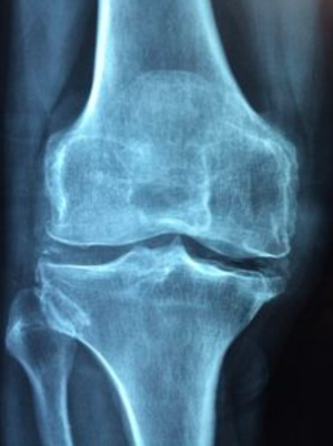Osteoarthritis can be related to a previous injury.