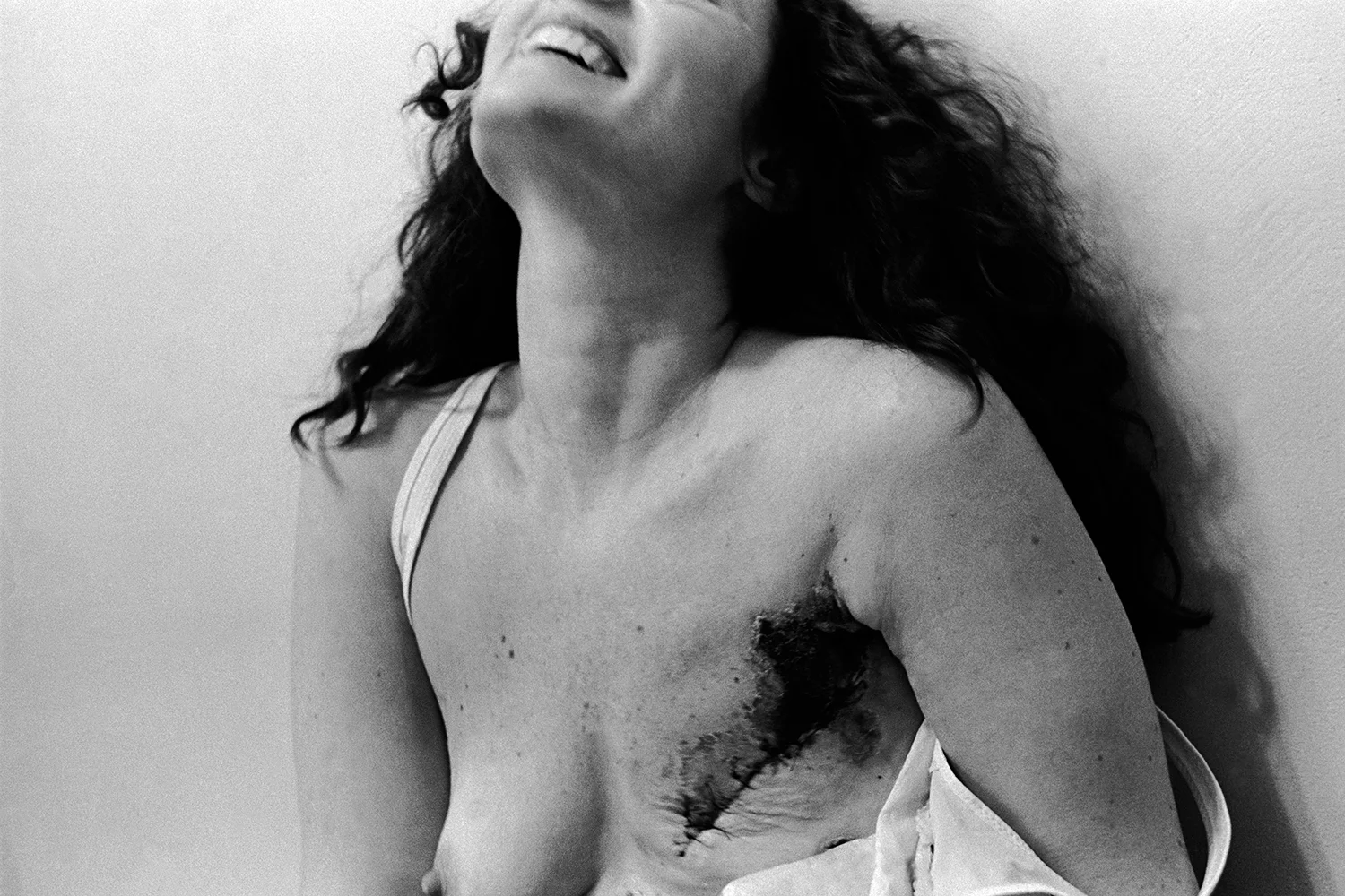 Mastectomy Boston Hospital for Women Boston, MA. 1978