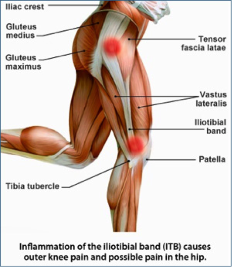 it-band.png