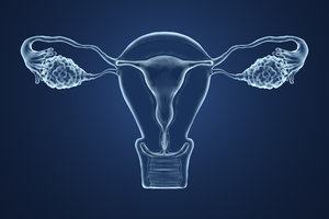 Addressing PCOS- Polycystic Ovarian Syndrome