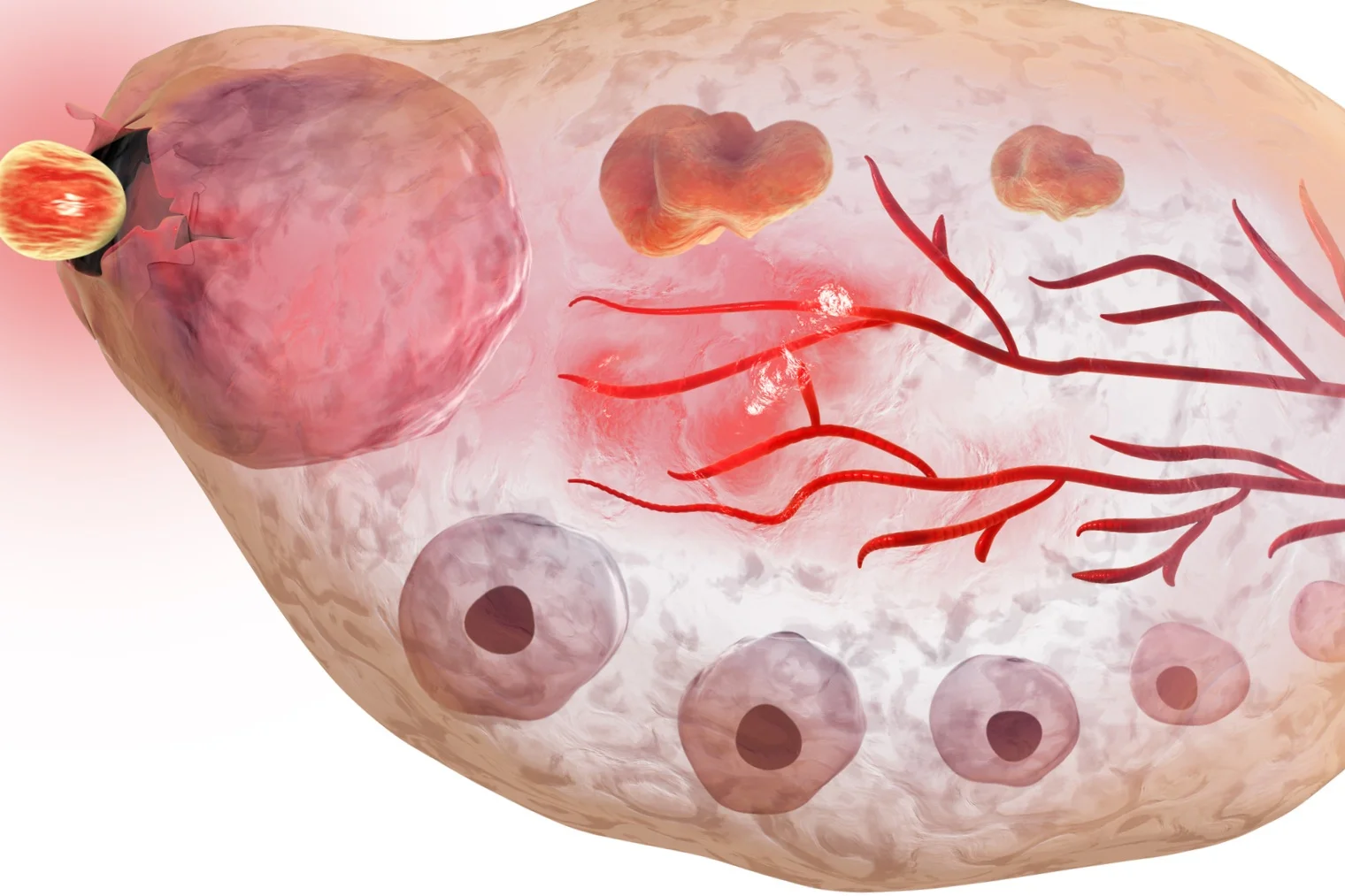 Nutritional Insights for Polycystic Ovarian Syndrome