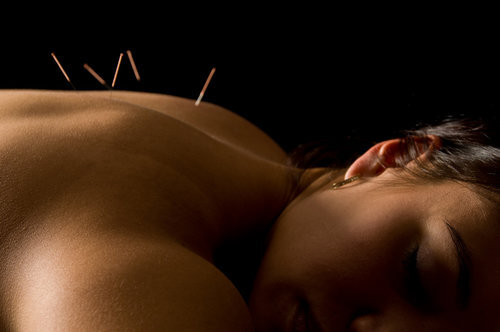 Erase Pain with Electroacupuncture