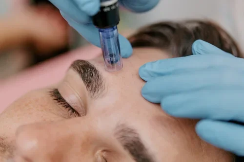 Microneedling at DHH: Your Skin's Most Luminous Chapter Starts Here