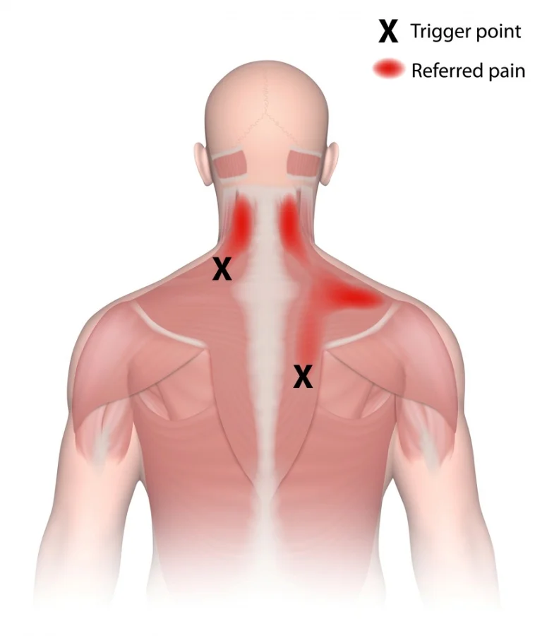 trigger-point-referred-pain-shutterstock_228843211.jpg