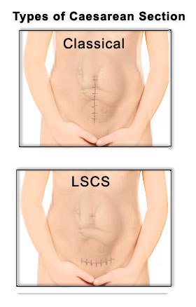 C-section Scars: Types Of Incisions, Healing, And Treatment I BabyChakra