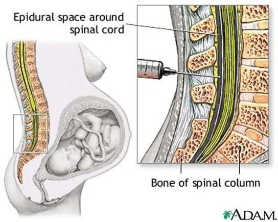 Figure 1: the epidural introduces pain medication into the membrane space surrounding the spine. this picture fails to show the surrounding muscles and ligaments that are in the area. 