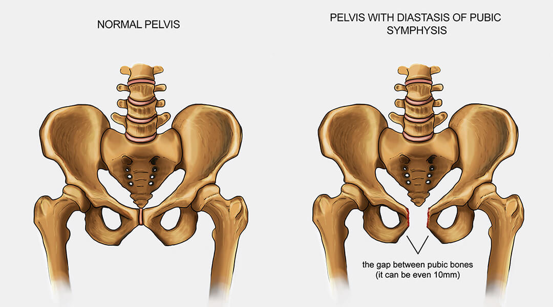 Symphysis Pubis Dysfunction in Pregnancy - The Chiropractic Solution -  Pillars of Health