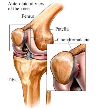 knee_runners_chond.png