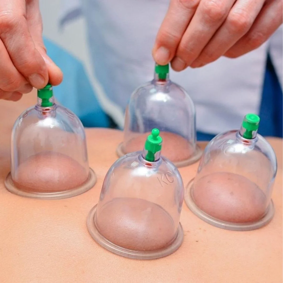 cupping.jpg