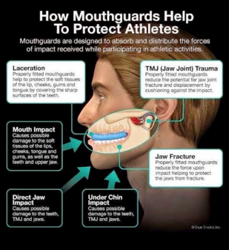 The Science Behind How Mouth Guards Work to Prevent Injury
