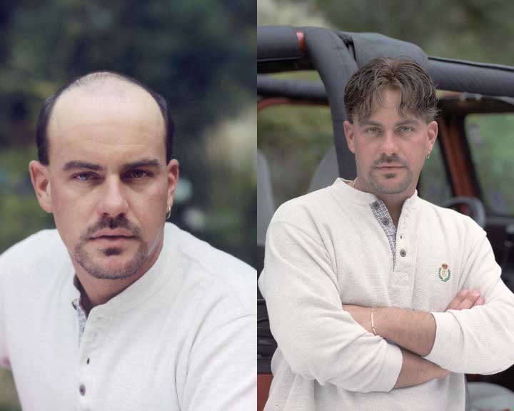 brian's amazing hair replacement transformation