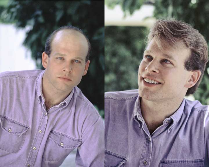 corey's amazing hair replacement transformation