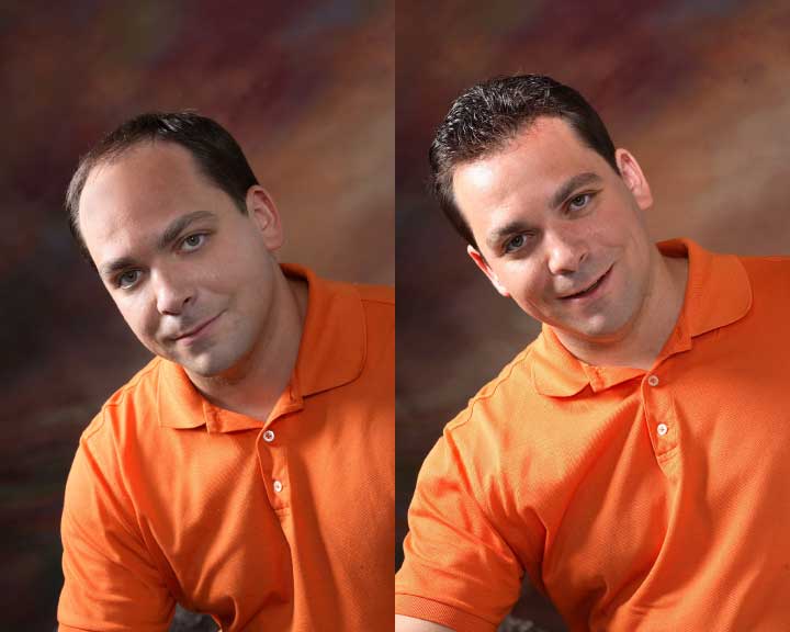 ken's amazing hair replacement transformation