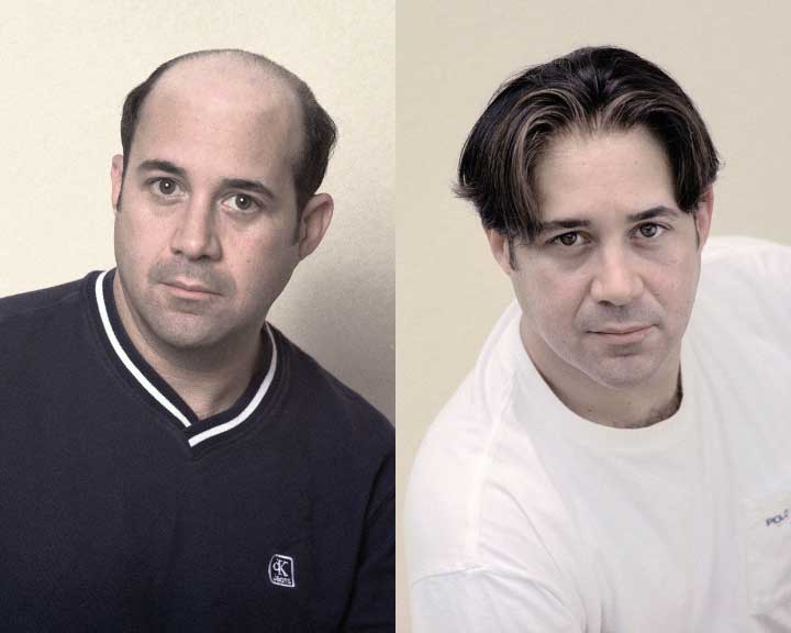 michael's amazing hair replacement transformation