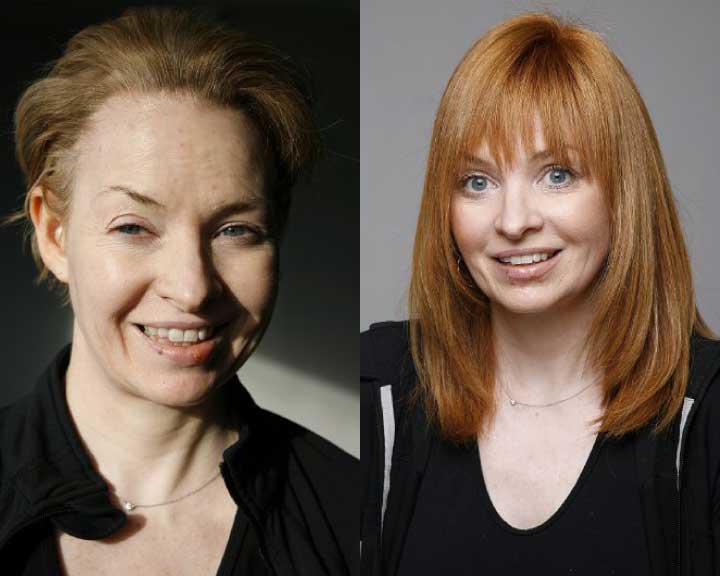ann's dramatic hair loss transformation