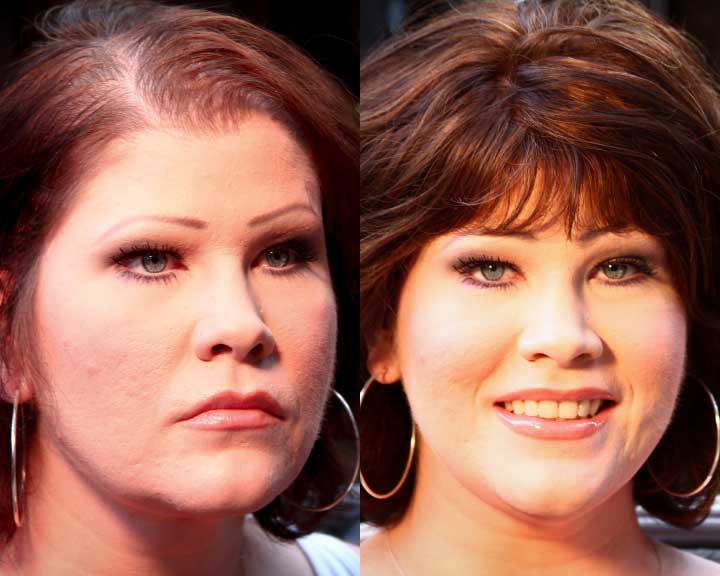 stacy's dramatic hair loss transformation