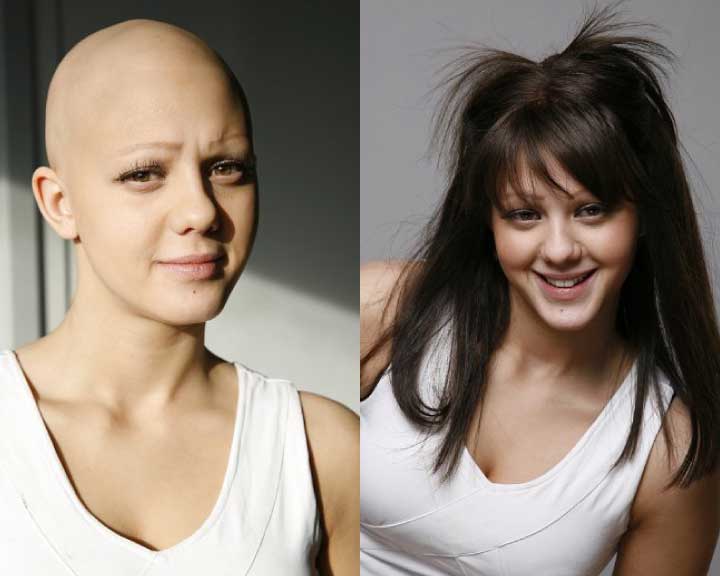   shawna's dramatic hair loss transformation  