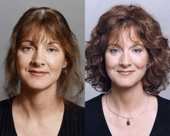 carly's dramatic hair loss transformation